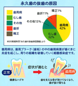 イラスト：永久歯の抜歯の原因